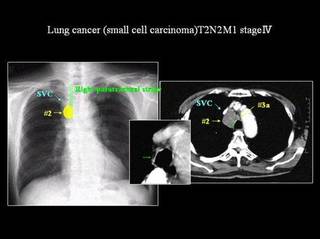 肺がん.jpg