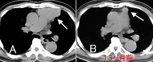 胸腺腫CT.jpg